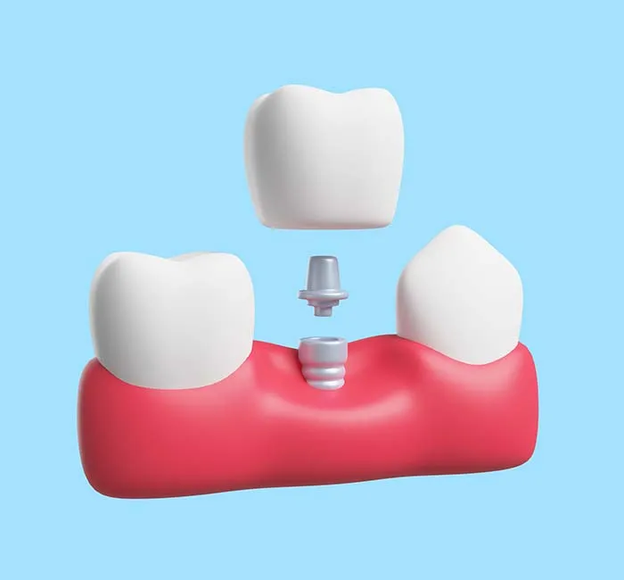انواع مختلف دندان مصنوعی و نحوه مراقبت از آنها