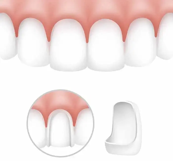 توضیحاتی در رابطه با دندان های پونتیک